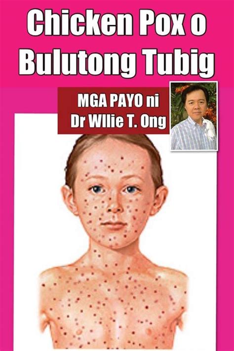 bulutong hangin picture|Bulutong (Chickenpox) .